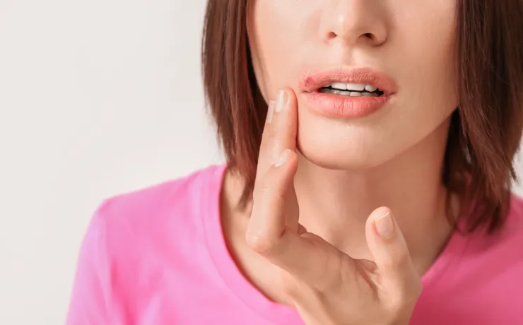 Cold Sore vs Canker Sore: How to Treat Them at Home